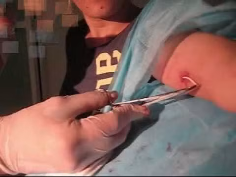 3. Sau khi rút que cấy, sự thụ thai hồi phục nhanh chóng và hoàn toàn. Có thể lấy que cấy bất cứ khi nào bạn muốn. Nếu bạn muốn có thai trở lại, hãy đến cơ sở y tế, nhân viên y tế sẽ lấy que cấy ra cho bạn.