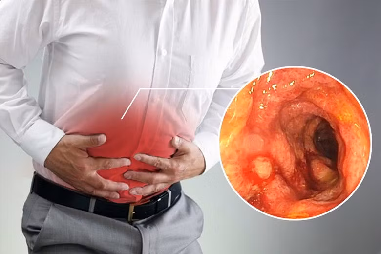 Gặp 3 sự cố này, khám ung thư trực tràng ngay còn kịp Gap 3 su co nay, kham ung thu truc trang ngay con kip