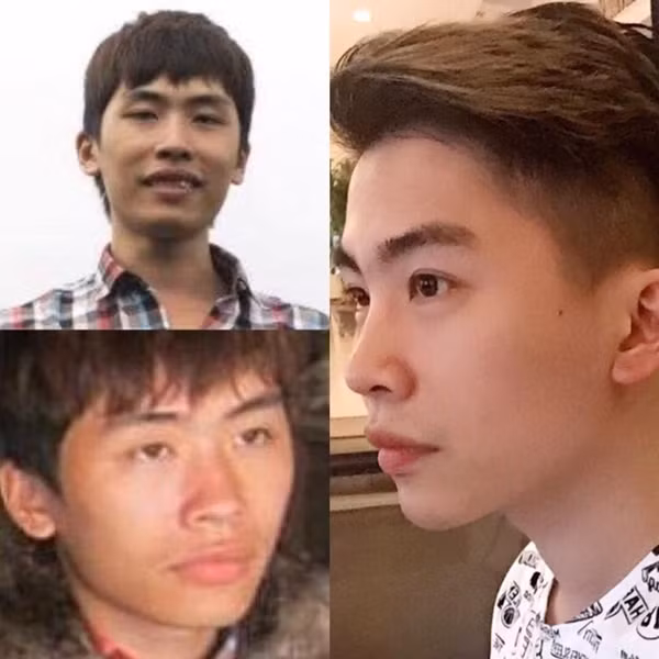"Mình tự thấy bản thân quá xấu. Có người bạn còn nói rằng, nếu mình không có tiền thì không có bạn bè, người khác yêu mình chỉ như làm từ thiện, rủ lòng thương cho số phận thiệt thòi. Mình quyết tâm thay đổi, muốn có một cuộc sống khác, cuộc sống của một người đẹp trai, thành đạt. Đó là lý do mình tìm đến tiêm thẩm mỹ”, Như Vũ chia sẻ.