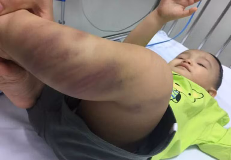 Trước đó, ngày 4/8, cháu Tiến Anh được một người đưa đến bệnh viện Việt Nam - Cu Ba trong tình trạng hôn mê, co giật, bầm tím toàn thân, xây xước ở cổ, bộ phận sinh dục. Sau khi cấp cứu hồi sức, bệnh nhi được chuyển tới bệnh viện Xanh Pôn, rồi đưa sang bệnh viện Nhi Trung ương.