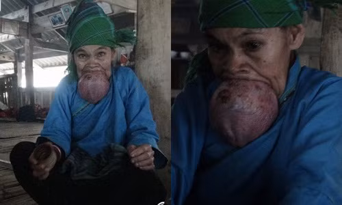 Cụ bà 60 tuổi hơn nửa đời chiếc đeo lưỡi khổng lồ Cu ba 60 tuoi hon nua doi chiec deo luoi khong lo