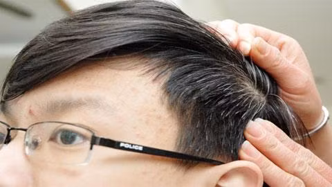 Theo Đông y nếu bạn bị bạc trắng tóc ở 2 bên thái dương trở lên trên đỉnh đầu là do gan đang có vấn đề.