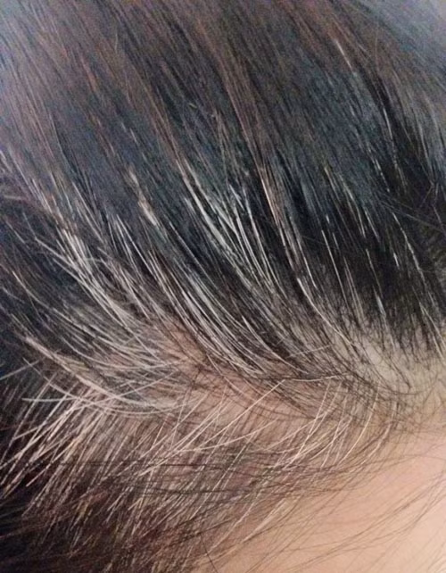 Những người trẻ nhưng tóc bạc trắng đầu, tóc muối tiêu là những người hay ưu phiền dễ xúc động, khả năng khống chế bản thân không được tốt.