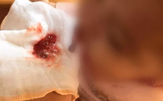 Viêm tuỵ cấp ở trẻ em như bệnh nhi 11 tuổi nguy hiểm thế nào? - Hình 2 Viem tuy cap o tre em nhu benh nhi 11 tuoi nguy hiem the nao?-Hinh-2