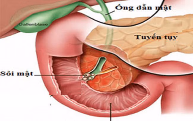 Viêm tuỵ cấp ở trẻ em như bệnh nhi 11 tuổi nguy hiểm thế nào? Viem tuy cap o tre em nhu benh nhi 11 tuoi nguy hiem the nao?