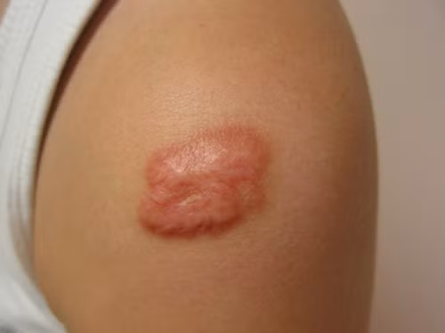 Vết sẹo lâu ngày có thể dẫn đến ung thư Vét sẹo lau ngày có thẻ dãn dén ung thu