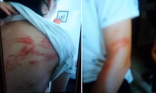 Hình ảnh những vết thâm tím, sẹo vẫn còn in hằn trên người cháu P. bị bố bạo hành.