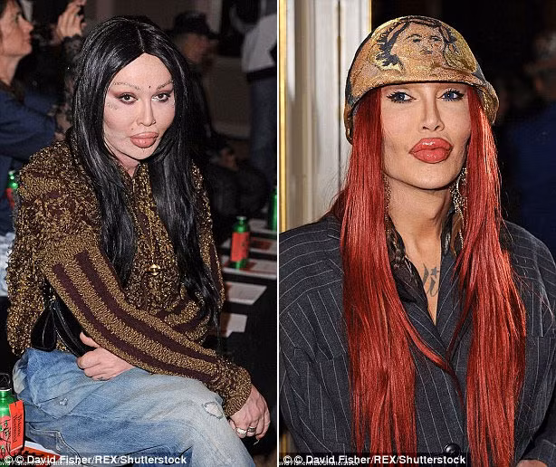 Sau nhiều lần bơm môi, đôi môi của Pete Burns càng ngày càng khủng khiếp và hậu quả là chất làm đầy bơm vào môi bắt đầu lan ra khắp khuôn mặt khiến da của anh bị lỗ chỗ và từ những chỗ đó rỉ ra những dịch vàng. (Ảnh: REX).