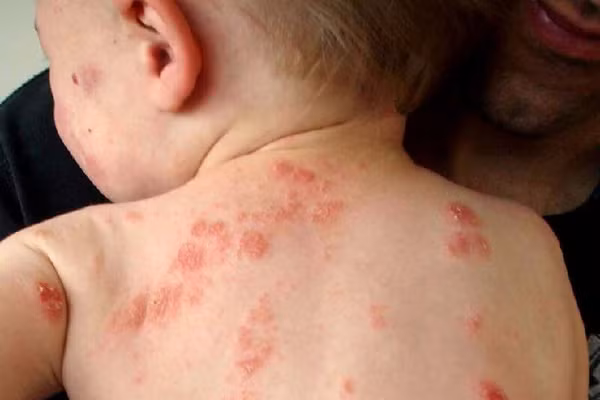  Viêm da cơ địa Có tới hơn 8.000 ca bệnh viêm da cơ địa vào khám, điều trị tại bệnh viện Da liễu TW tháng 5 và 6 ở đủ các lứa tuổi, trong đó trẻ em chiếm đa số.
