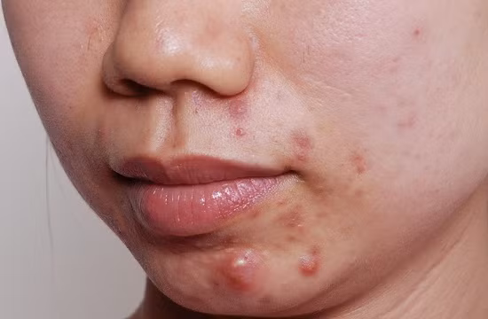 Trong 2 tháng 5 và 6/2018, có tới gần 9.000 ca bệnh tới khám tại Da liễu TW, bao gồm trứng cá bọc, trứng cá đầu đen, trứng cá mủ.