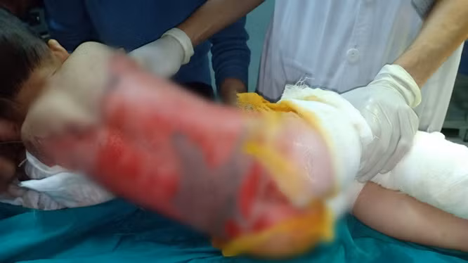 Tuyên Quang: Cảnh báo nhiều trẻ nhỏ bị bỏng nước sôi Tuyen Quang: Canh bao nhieu tre nho bi bong nuoc soi