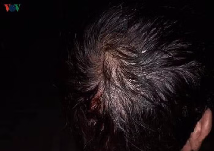 Mưa đá trút xuống như thác đổ đã làm nhiều người bị thương nặng, trong đó có 2 người phải đưa đi cấp cứu tại cơ sở y tế.