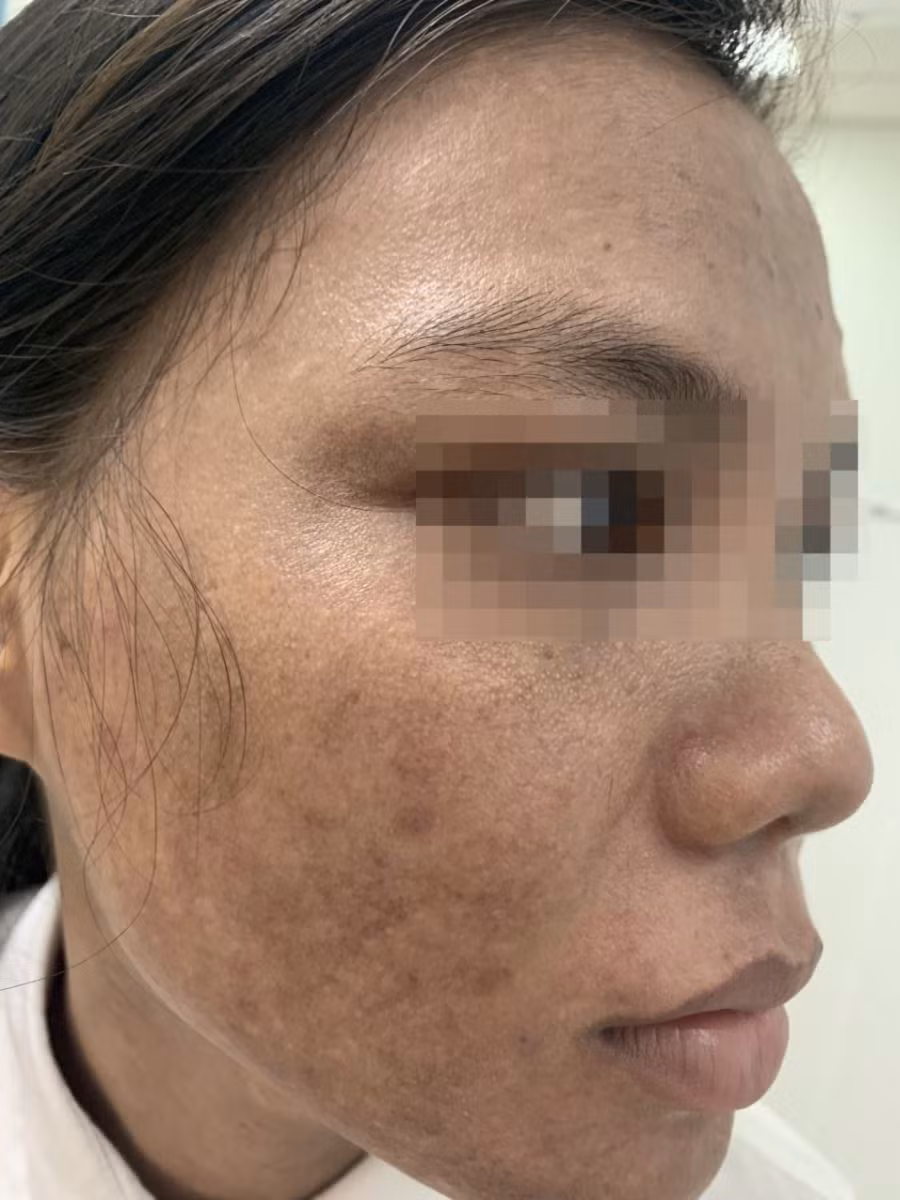 Hồi tháng 9/2019, chị T.P.T. (tỉnh Đăk Lăk) chưa tới 30 tuổi nhưng mặt đã xuất hiện nhiều vết nám. Do đó, chị T. lên mạng tìm hiểu và tự điều trị vết nám tại nhà bằng một loại kem trộn không rõ nguồn gốc được quảng cáo trên mạng. Sau vài ngày sử dụng chị T. bị ngứa rát nhẹ, bong vảy vùng mặt và cổ. Lo lắng vì tổn thương da mặt ngày càng nhiều, chị T. đã đến một spa ở gần nhà để điều trị và được cơ sở này cho một loại thuốc thoa không nhãn mác.