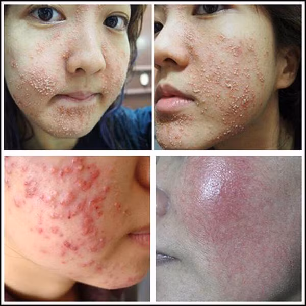 Bác sĩ Trần Nguyễn Ánh Tú - Trưởng Khoa Thẩm mỹ da Bệnh viện Da liễu TP.HCM cho biết, đa số trường hợp chị em muốn làm đẹp nhanh thường mua những sản phẩm làm trắng mà thành phần thường có là corticoid. Khi bị tổn thương, nếu chậm trễ điều trị, khả năng phục hồi rất lâu.