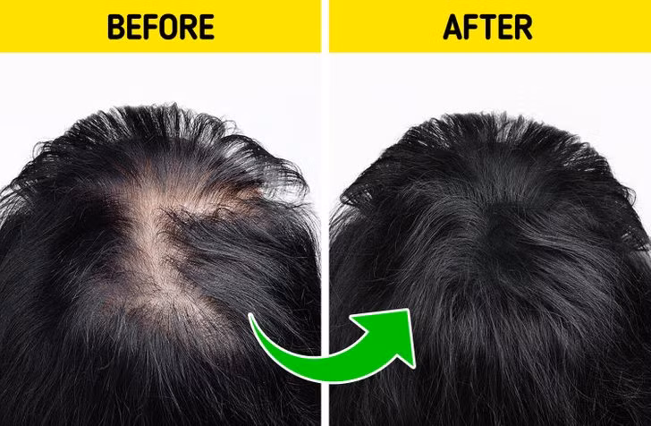 Sử dụng trà xanh: Đối với tóc, trà xanh cũng có tác dụng hiệu quả, bởi nó có chứa epigallocatechin gallate giúp tóc mọc lên nhanh và khỏe hơn. Trong một nghiên cứu nhỏ, những người bị hói đầu đã tình nguyện uống một loại thực phẩm bổ sung mới có chứa chiết xuất trà xanh, vitamin D, Omega-3, Omega-6 và các nguyên tố khác. Kết quả cho thấy ở 80% số người tham gia nghiên cứu, tóc đã mọc lại rất ấn tượng.