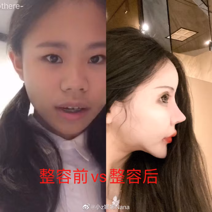Ngoài việc đăng tải hình ảnh so sánh bản thân trước và sau khi "đập mặt xây lại", Nana còn đính kèm thêm những tờ hóa đơn, thông tin chuyển khoản để chứng minh việc phẫu thuật.