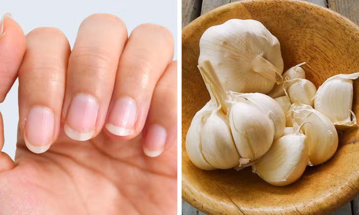 Tỏi cũng chứa nhiều thành phần có tính kháng khuẩn, ngăn vi khuẩn, nấm phát triển. Hãy nghiền nát vài tép tỏi tươi sau đó đặt chúng lên vùng móng nhiễm nấm. Kiên trì với cách này hàng ngày sẽ giúp vùng khóe móng nhanh phục hồi, khỏe mạnh trở lại. Ảnh: BS. Video "Bí quyết làm đẹp của sao Việt". Nguồn: VTC.