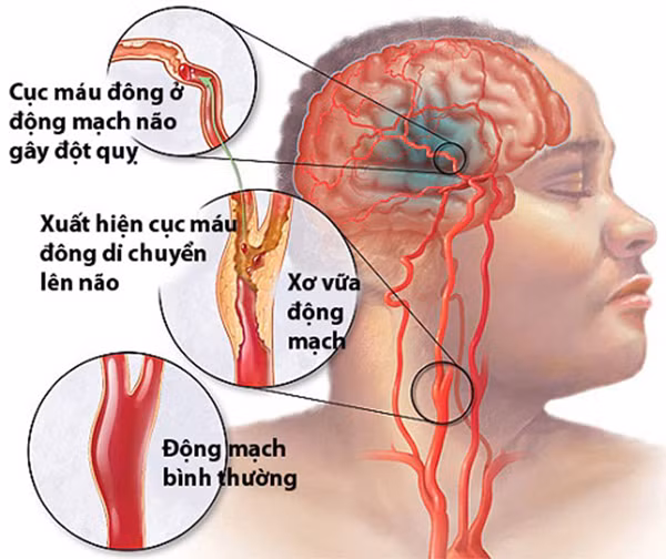 Nhac si Phu Quang mac bien chung tieu duong nguy hiem toi muc nao?-Hinh-3