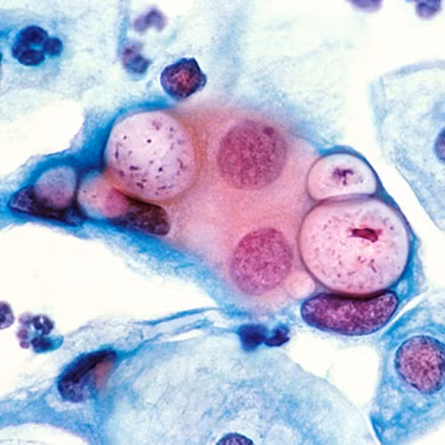 Bệnh lây qua đường tình dục. Các bệnh lây truyền qua đường tình dục như chlamydia và bệnh lậu có thể dẫn đến viêm xương chậu và khó thụ thai. Thực tế, khuẩn chlamydia có thể gây viêm ống dẫn trứng mà không có biểu hiện gì khác. Nhiều chị em không biết có bệnh đến khi khó có bầu. Ngoài ra, viêm âm đạo không dẫn đến vô sinh.