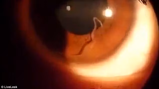 Video khung khiep ky sinh trung ngo nguay trong mat