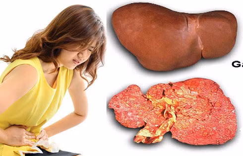 Căn bệnh ung thư đứng đầu Việt Nam: Bất ngờ "thủ phạm" từ người mẹ Can benh ung thu dung dau Viet Nam: Bat ngo