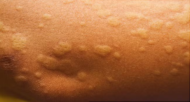 Sốc phản vệ khi ăn sá sùng: Lời cảnh báo đừng chủ quan Soc phan ve khi an sa sung: Loi canh bao dung chu quan