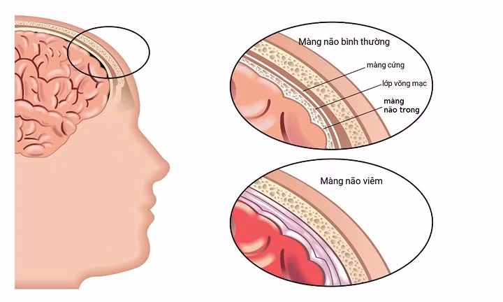 Viêm màng não: Theo MSN, viêm màng não thường do vi khuẩn hoặc virus gây ra, gây nhiễm trùng màng bảo vệ bao quanh não và tủy sống. Bệnh nguy hiểm xuất hiện nhiều ở trẻ sơ sinh, trẻ nhỏ và thanh thiếu niên.
