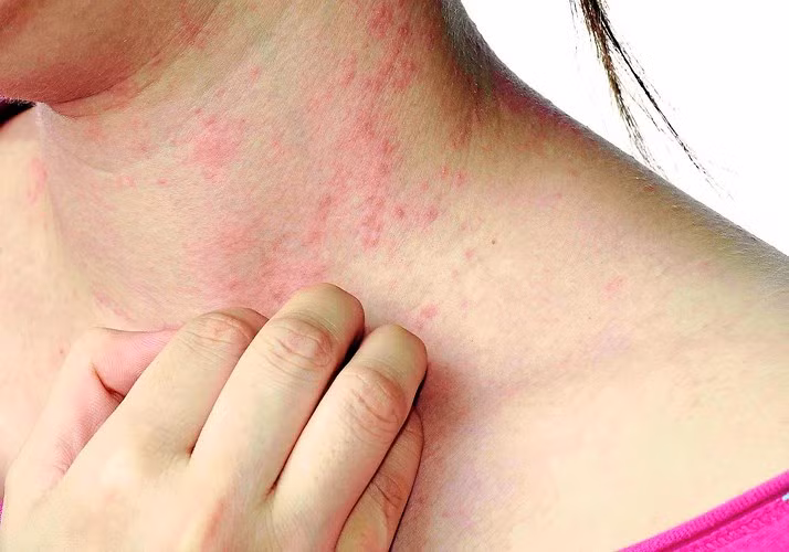 Viêm cân mạc hoại tử: Đây là bệnh nhiễm trùng da cực kỳ nguy hiểm do vi khuẩn gây ra. Nhiễm trùng sẽ nhanh chóng lây lan đến các mô mềm của cơ thể. Tỷ lệ tử vong khi mắc bệnh là khoảng 30 đến 40%. Thông thường, các bác sĩ phải cắt bỏ các cơ quan bị nhiễm trùng để ngăn ngừa vi khuẩn lây lan.