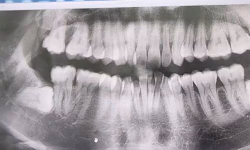 Răng khôn đâm thủng má, cô gái trẻ phải bỏ thai Rang khon dam thung ma, co gai tre phai bo thai