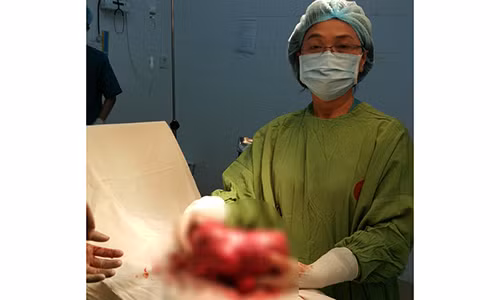 Bụng to như thai 8 tháng, bóc ra u xơ 2,5 kg Bung to nhu thai 8 thang, boc ra u xo 2,5 kg