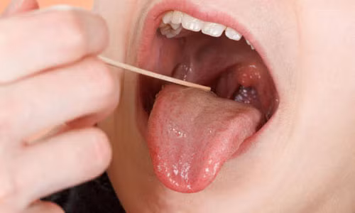 Soi những triệu chứng ung thư lưỡi Soi nhung trieu chung ung thu luoi