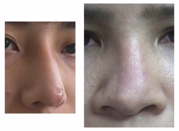 Trong một trường hợp khác, cô gái này bị tụt sụn khi để lộ 1 điểm lõm trên mũi. Trong một trường hợp khác, cô gái này bị tụt sụn khi để lộ 1 điểm lõm trên mũi.