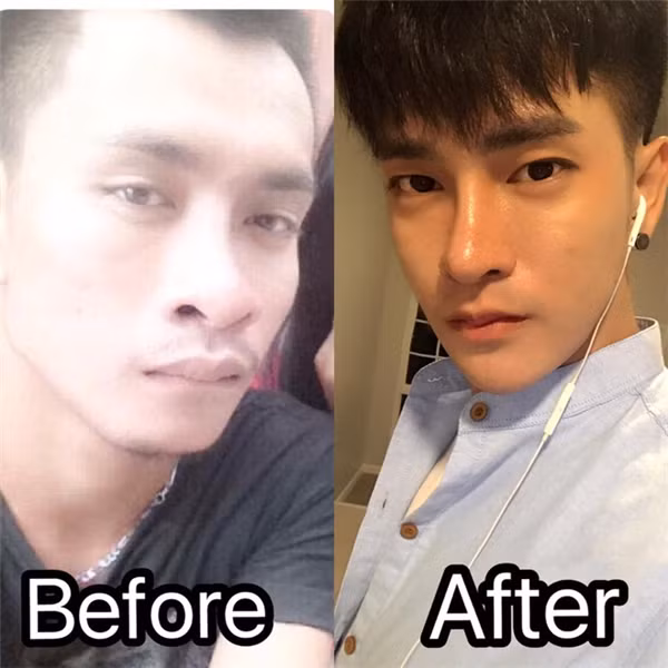 Vừa qua, dân mạng Thái Lan lại dậy sóng với hình ảnh của một thanh niên "nghiện" phẫu thuật thẩm mỹ đến mức đã đầu tư hơn 10 lần chỉnh sửa với mong ước có được một khuôn mặt hoàn hảo, điển trai giống như các "oppa" Hàn Quốc.