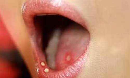 3 dau hieu vung dau co phai nghi ngay den ung thu luoi