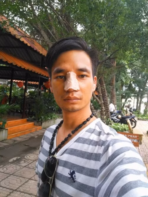 Can canh khuon mat "khong con hien" sau phau thuat cua Le Roi
