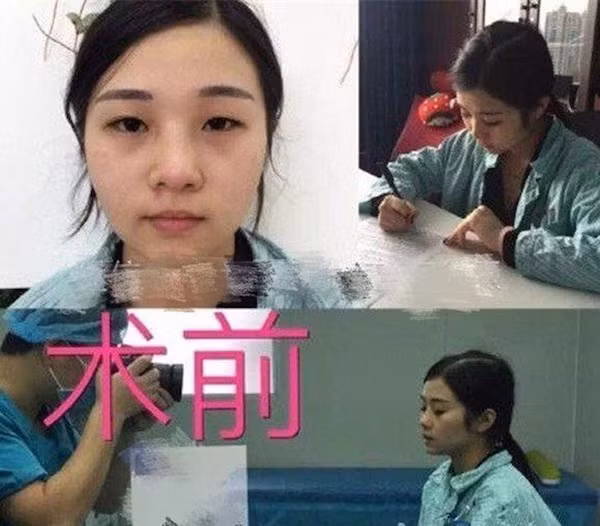 Khi chỉ mới 15 tuổi, cô nàng đến từ Thâm Quyến - Quảng Đông đã bắt đầu tiến hành phẫu thuật thẩm mỹ với mong muốn sở hữu dung mạo giống hệt như thần tượng của mình.