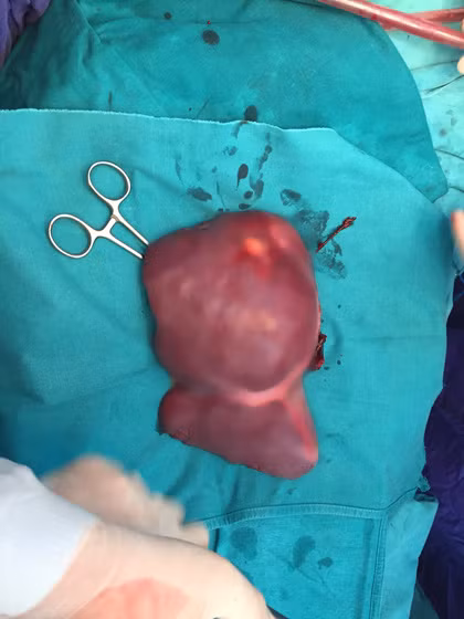 Tại một phòng mổ khác khối gan hỏng của bệnh nhân đã được PGS Nguyễn Tiến Quyết cắt bỏ để đưa lá gan mới vào cơ thể bệnh nhân T.N.H, 59 tuổi, ở Hà Nội.