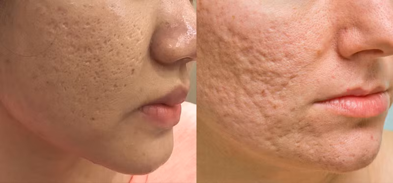 Serum sẹo rỗ của Lá House có thật sự hiệu quả? - Hình 4 Serum seo ro cua La House co that su hieu qua?-Hinh-4