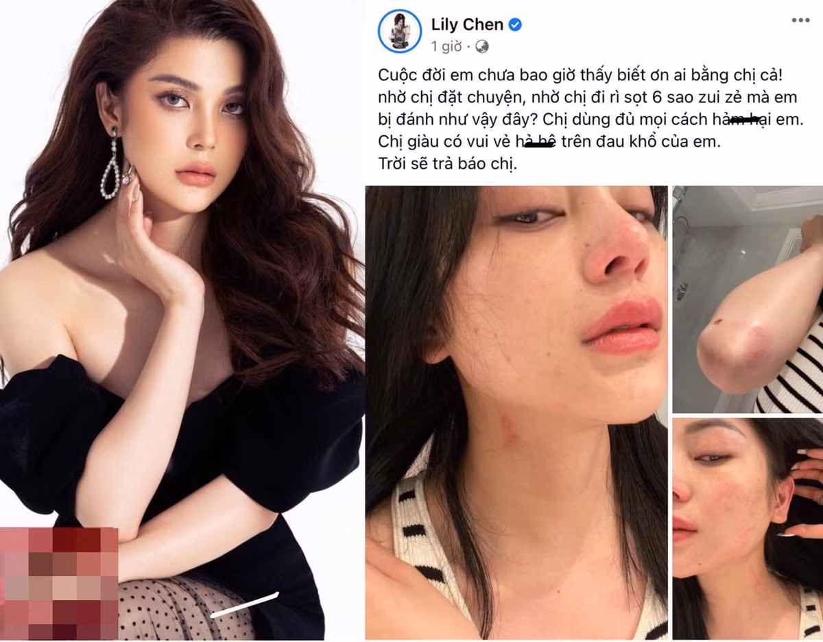 Trưa 2/11, Lily Chen có bài đăng gây chú ý trên trang cá nhân. Cô tung loạt ảnh bầm dập từ mặt tới thân do bị hành hung.
