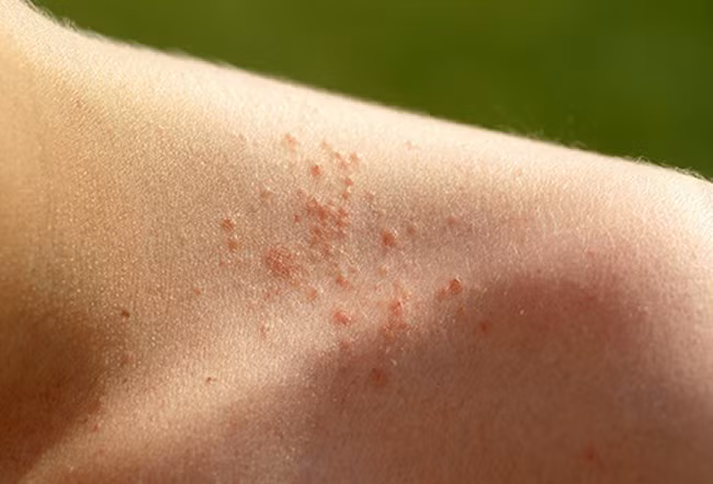 Phát ban nhiệt: Khi thời tiết nóng ẩm, bạn có thể đổ mồ hôi nhiều đến mức các tuyến mồ hôi bị tắc. Các lỗ chân lông không thể thoát nước sẽ khiến rôm sảy nổi lên. Bạn nên mặc trang phục rộng, sáng màu với chất liệu thấm mồ hôi để tránh tình trạng này.
