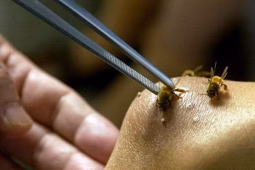Vì sao bị ong vò vẽ đốt có thể tử vong sau 15 phút? - Hình 3 Vi sao bi ong vo ve dot co the tu vong sau 15 phut?-Hinh-3