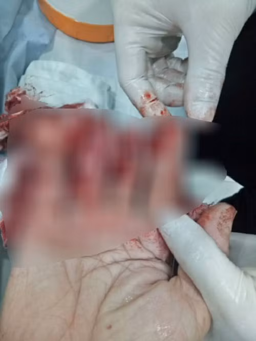 Các bác sĩ không thể nối lại ngón tay do người nhà bệnh nhân bảo quản sai cách. Ảnh: Người lao động.