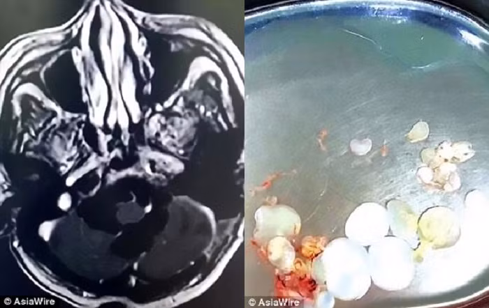 Bác sỹ phát hiện hàng chục trứng sán dây trong đầu người đàn ông ăn thịt sống.