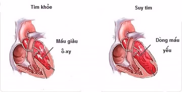 Độc tính trên tim: Tác dụng trên tim có thể xảy ra vào lúc bắt đầu hoặc trong khi điều trị hóa trị. Hiệu ứng này đôi khi có thể nhẹ và có thể bao gồm những thay đổi về huyết áp. Trong trường hợp nặng, nó có thể dẫn đến suy tim.