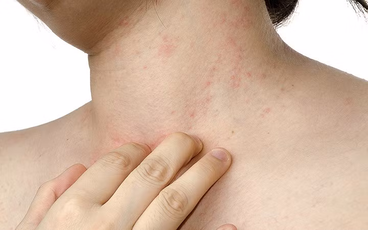 Dị ứng: Ăn mật ong sống cũng có thể bị dị ứng nhẹ đến trung bình. Tình trạng này có thể tồi tệ hơn ở những người bị dị ứng với hạt phấn hoa. Nếu là mật hoa chưa qua chế biến có thể chứa phấn hoa, thuốc trừ sâu và rất nhiều hóa chất khác. Dùng trực tiếp có thể dẫn đến sự phát triển của các triệu chứng dị ứng như sưng, ngứa, viêm, phát ban, phát ban, bọng, ho, hen suyễn, thở khò khè, viêm mũi, khó thở, khó nuốt...