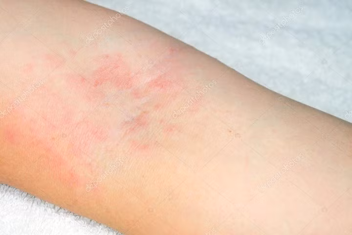 Làm hại da: Có khoảng 60 - 80% bệnh nhân bị nhiễm độc da sau khi điều trị ung thư bằng hóa trị. Những ảnh hưởng của phương pháp điều trị này là da khô, phát ban da, ngứa, viêm niêm mạc và lông mọc bất thường.