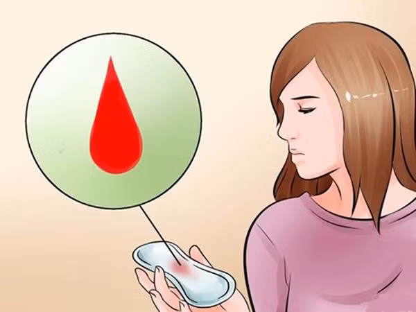Xuất huyết bất thường trong kì kinh là dấu hiệu u xơ tử cung. (Ảnh minh họa). Xuất huyết bất thường trong kì kinh là dấu hiệu u xơ tử cung. (Ảnh minh họa).
