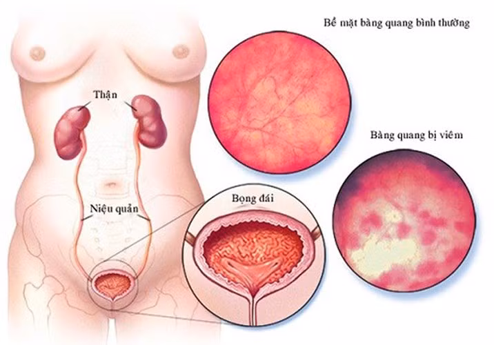 Viêm bàng quang xuất huyết: Đây là một tác dụng phụ phổ biến khác của hóa trị liệu. Viêm bàng quang xuất huyết có thể xảy ra trong quá trình điều trị hoặc sau khi điều trị bằng hóa trị. Các triệu chứng chung là đau bất thường, khó tiểu, tiểu máu,...