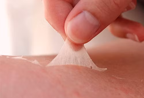 Vùng da cháy nắng dễ bị bong tróc. Vùng da cháy nắng dễ bị bong tróc.