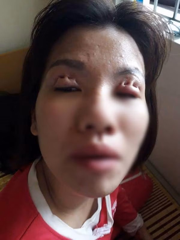 Trong năm qua, cộng đồng mạng liên tục hoang mang khi chứng kiến nhiều trường hợp phẫu thuật thẩm mỹ cắt mí, nhấn mí mắt hỏng. Đôi mắt là cửa sổ tâm hồn mà cứ như khâu quần áo vậy.